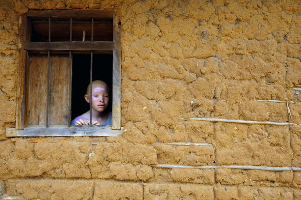 Sikogwa Mangalu, de 5 años, vive separada de sus padres en un refugio construido por el gobierno de Tanzania para niños albinos. La mayoría de los casos de ataques y asesinatos son contra menores. Foto: Liron Shimoni.