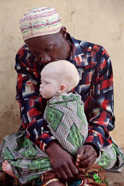 Un padre visita a su hijo refugiado en uno de los centros para albinos al norte de Tanzania. Foto: Liron Shimoni. 