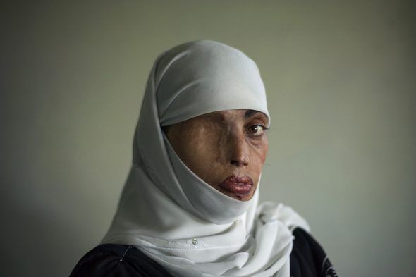 Esta mujer se llama Busha Shari y fue atacada con ácido por su marido en Islamabad, Pakistán. 