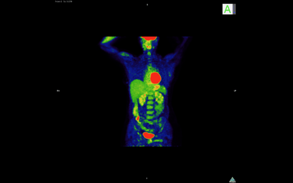 : Renderización de tomografía por emisión de positrones (PET). Las zonas rojas corresponden a tumores / metástasis. Imagen: Unidad de Imagen Molecular / CNIO