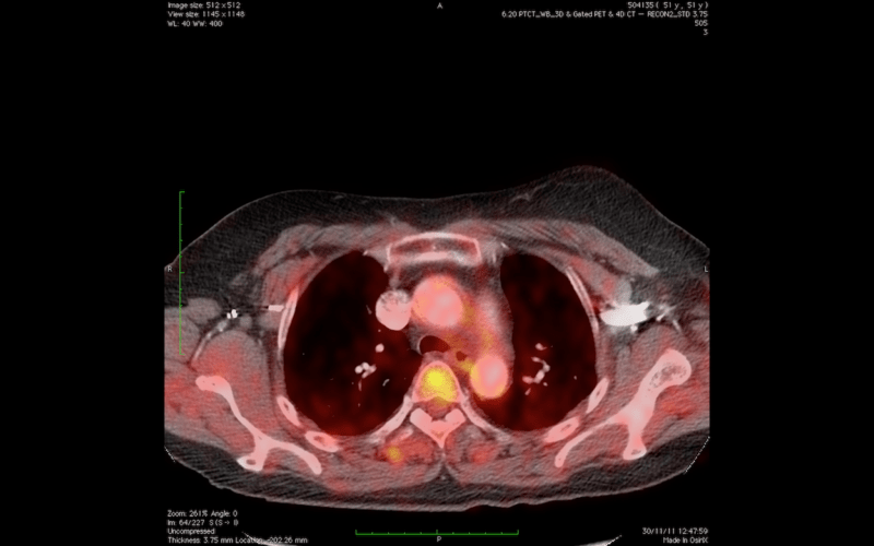 Wholebody converted: combinación de tomografía computarizada y tomografía por emisión de positrones (CT/PET). Imagen: Unidad de Imagen Molecular / CNIO