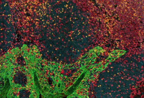 3.Los glóbulos blancos o linfocitos CD4, en rojo, y CD8, en amarillo, se infiltran entre las células del epitelio que recubre las amígdalas (verde). La distribución espacial de las células inmunitarias y su relación con el tumor, así como con otras células inmunitarias, se estudia con microscopía óptica avanzada. Imagen de Zeiss Axioscan 7, obtenida por las unidades de Microscopía Confocal e Histopatología del CNIO. 